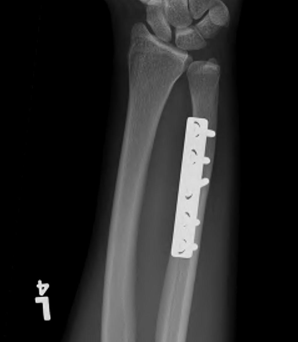 Ulna Shortening